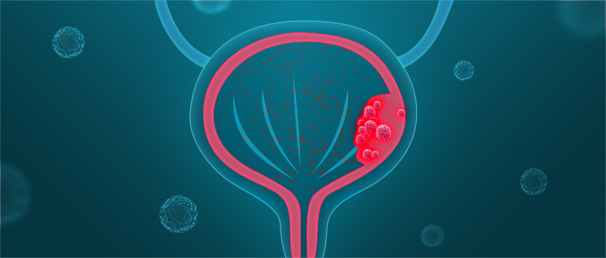 SOX2基因敲除细胞助力膀胱癌无创诊断——T1DMR/T2DMR检测法
